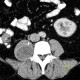 Schwannoma of psoas muscle: CT - Computed tomography